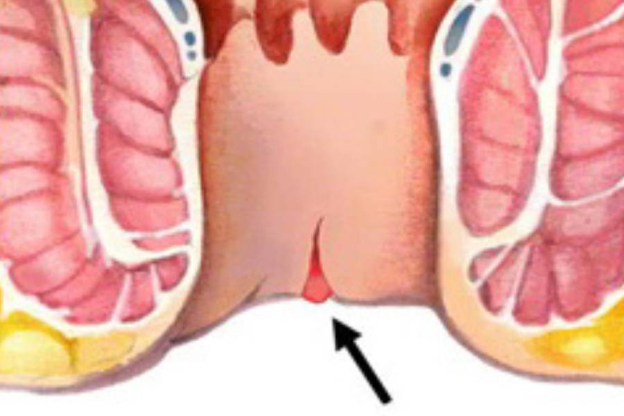 Fissure Treatment in New Delhi by Fissure Specialist Dr. Jayadatt Pawar
