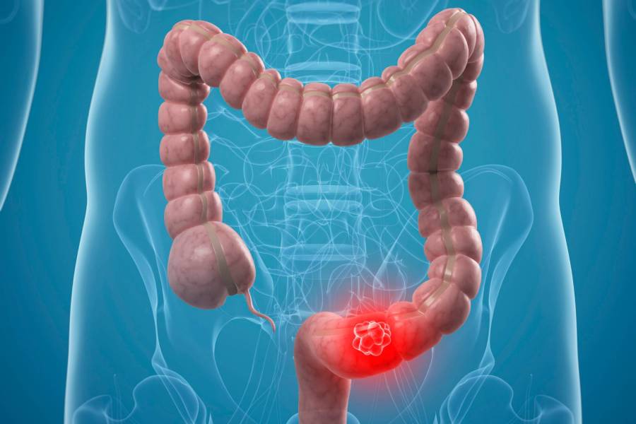 Best Colon Cancer Doctors in Delhi – Colon Cancer Treatment in New Delhi by Dr. Jayadatt Pawar