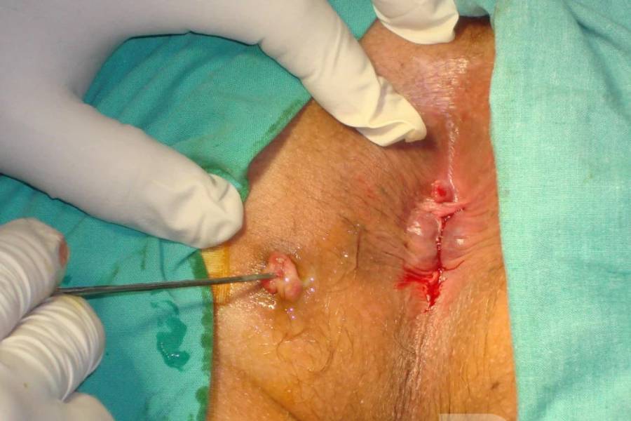 Fistula Treatment in New Delhi and Faridabad by Dr. Jayadatt Pawar