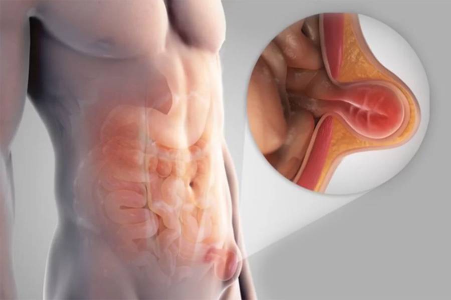 Best Hernia Surgeon in New Delhi – Dr. Jayadatt Pawar | Leading Hernia Specialist in New Delhi