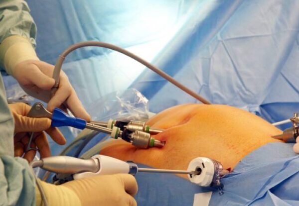 Best Laparoscopic Surgeon in New Delhi | Dr. Jayadatt Pawar performing Laparoscopic Surgery in New Delhi