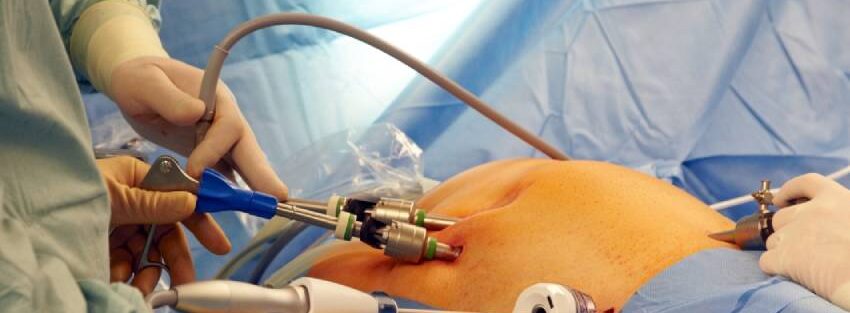 Best Laparoscopic Surgeon in New Delhi | Dr. Jayadatt Pawar performing Laparoscopic Surgery in New Delhi