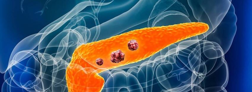 Pancreatic Cancer Awareness Month – Early Detection Guidance by Dr. Jayadatt Pawar