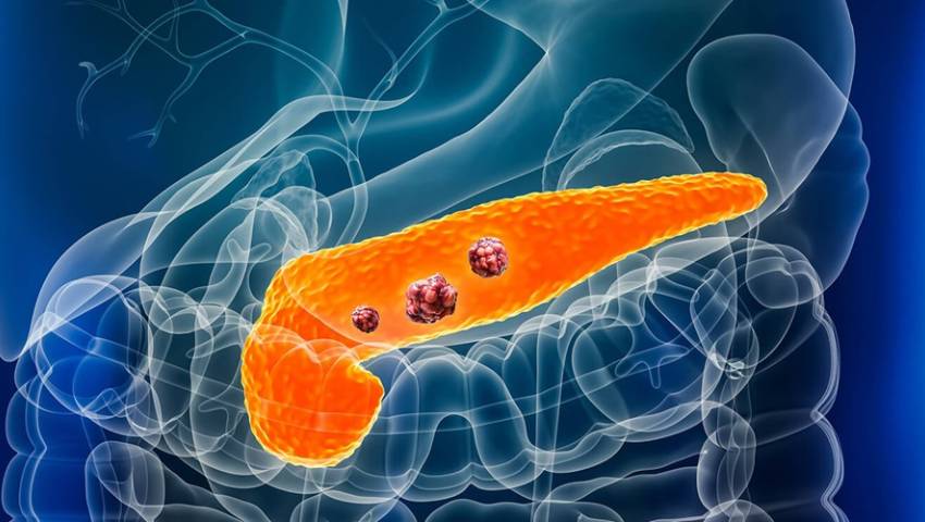 Pancreatic Cancer Awareness Month – Early Detection Guidance by Dr. Jayadatt Pawar