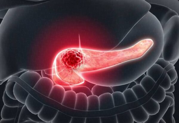 Role of Surgery in Pancreatic Cancer – Whipple Procedure Overview
