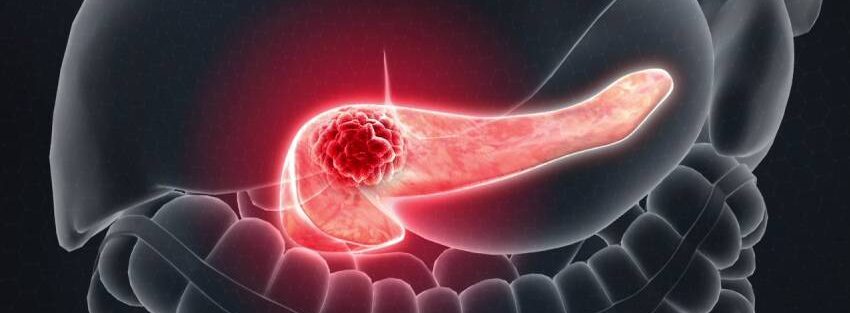 Role of Surgery in Pancreatic Cancer – Whipple Procedure Overview