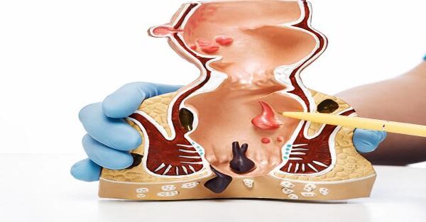 Best Anal Fissure Treatment and how to cure fissure permanently by Dr. Jayadatt Pawar