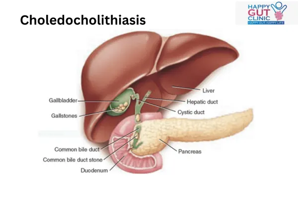 Choledocholithiasis meaning diagram showing Gallstones and Choledocholithiasis in the common bile duct explained by Dr. Jayadatt Pawar