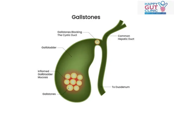 Cholelithiasis meaning diagram showing gallstones in the gallbladder with liver and bile ducts explained by Dr. Jayadatt Pawar