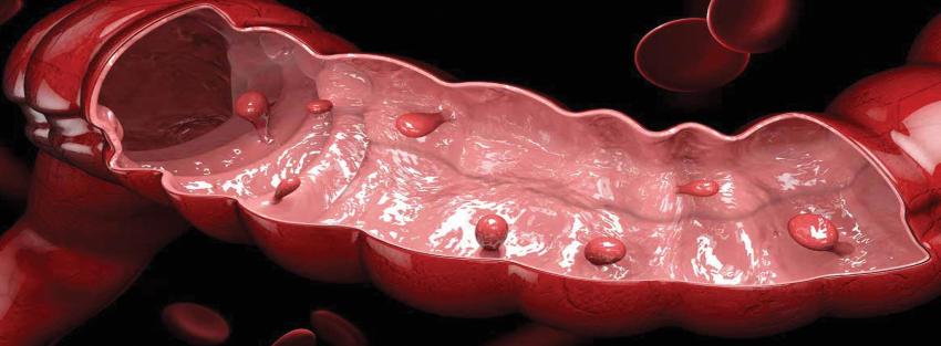 Colon Polyps Symptoms and Colorectal Polyps diagnosis explained by Dr. Jayadatt Pawar