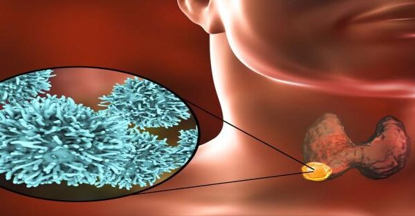 Thyroid Surgery procedure showing thyroidectomy – When Is Thyroid Surgery Needed treatment guide