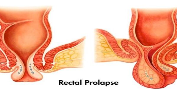 Rectal prolapse Symptoms causes and treatment